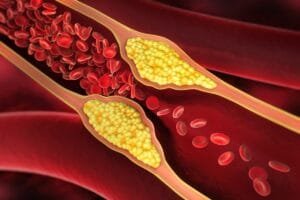As 3 bebidas que mais prejudicam as artérias