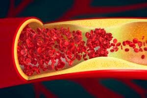 Reverter quadro de gordura nas artérias