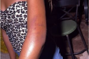 Menina agredida por PM no Carnaval relata dor e falta de ajuda