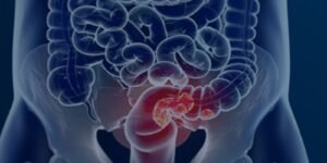 Novo Programa de Rastreamento do Câncer Colorretal no SUS